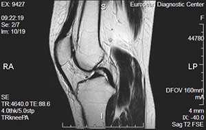 МРТ коленного сустава: современное лечение и диагностика на высокоточном оборудовании