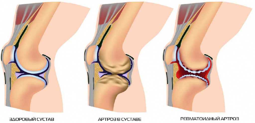 Физиотерапевтическое лечение остеоартроза тазобедренного сустава