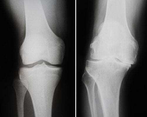 Остеопороз коленного сустава у женщин: причины, симптомы, лечение
