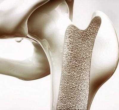 Симптомы остеопороза коленного сустава у женщин