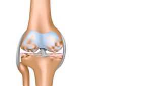 Основные признаки остеохондроза коленного сустава 1 степени