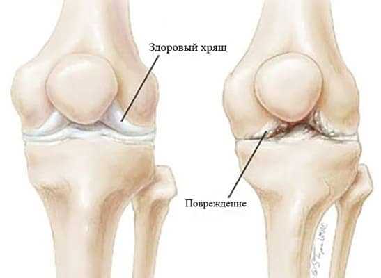 Периартрит коленного сустава: симптомы, лечение, препараты