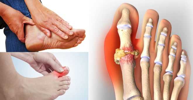 Лечение подагры коленного сустава