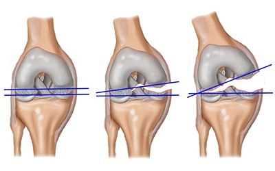 Профилактика растяжения мышц коленного сустава
