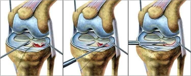 Разрыв мениска коленного сустава 2 степени: причины, симптомы и лечение