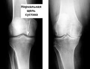 Признаки и симптомы ревматоидного артрита коленного сустава: