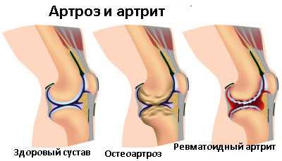 Ревматоидный артрит коленного сустава: признаки, симптомы, диагностика и лечение