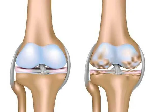 Стандарт лечения артроза коленного сустава по министерству здравоохранения