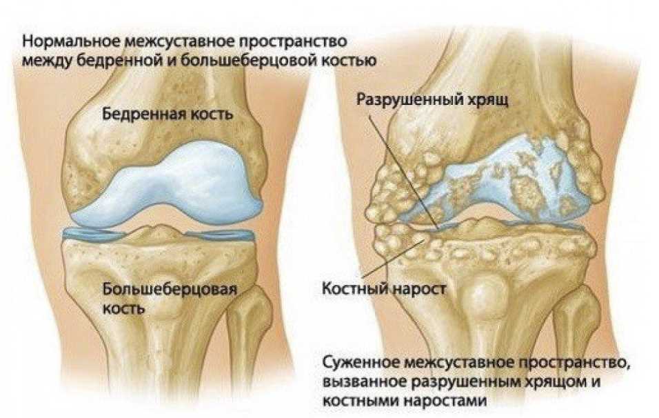 Традиционные методы лечения дефартроза коленного сустава