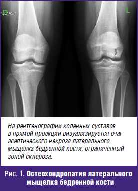 Воспаление в коленном суставе у ребенка: эффективное лечение и рекомендации