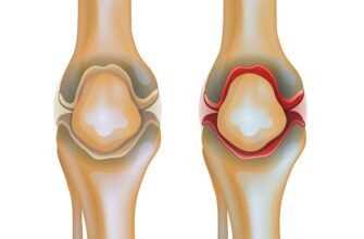 Воспалительный процесс коленного сустава: эффективное лечение
