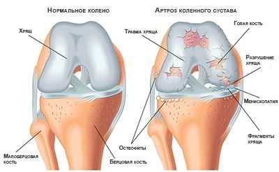 Заболевание коленного сустава: причины, симптомы, лечение