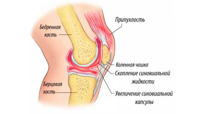 Симптомы заболевания коленного сустава