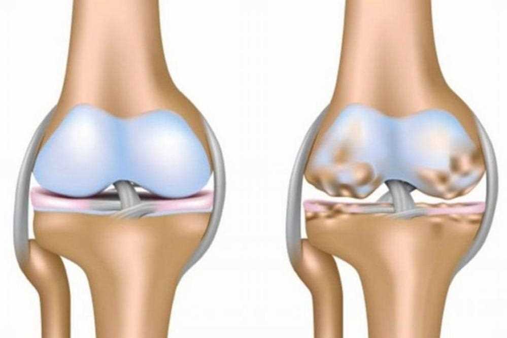 Отзывы о народных методах лечения артроза коленного сустава