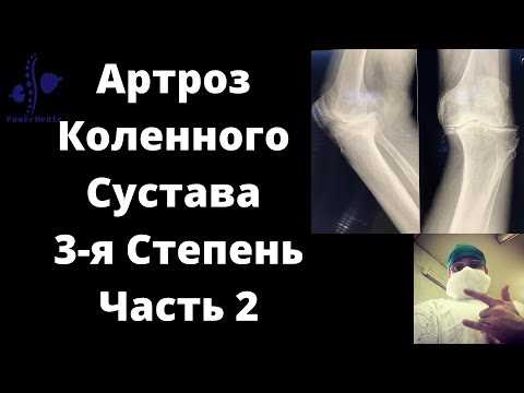 Медикаментозное лечение артроза коленного сустава от доктора Евдокименко