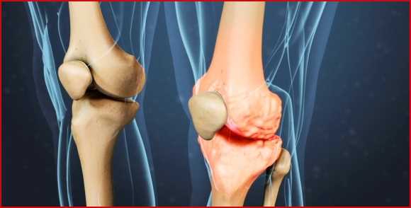 Основные методы диагностики артрита коленного сустава: