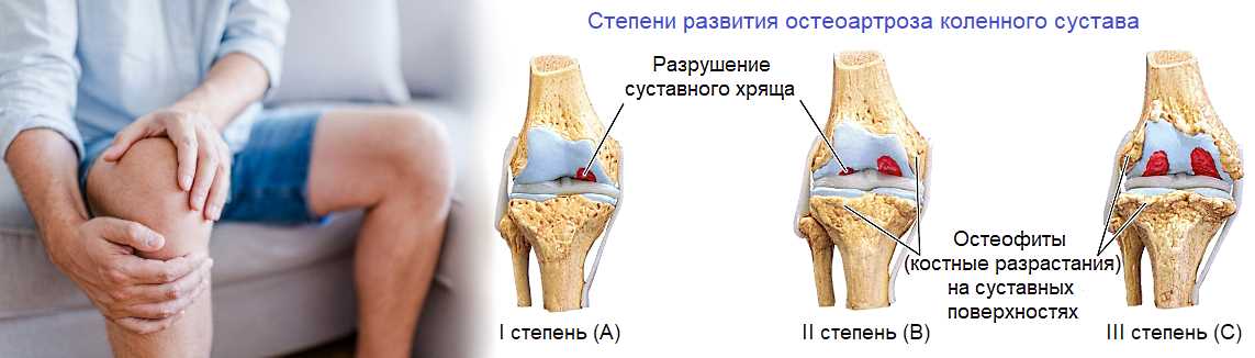 Прогрессирование артроза коленного сустава