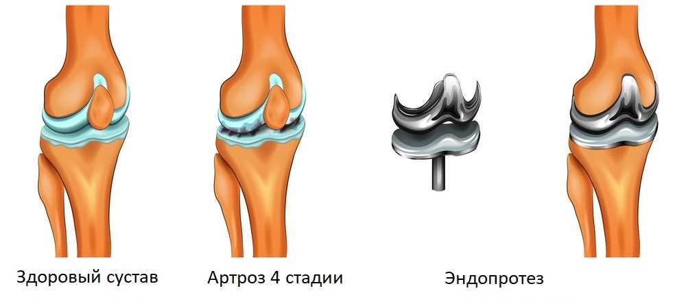 Профессиональная помощь при лечении артроза коленного сустава