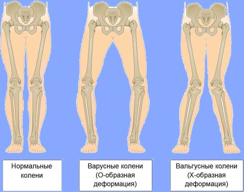 Немедикаментозные методы лечения рекурвации коленного сустава