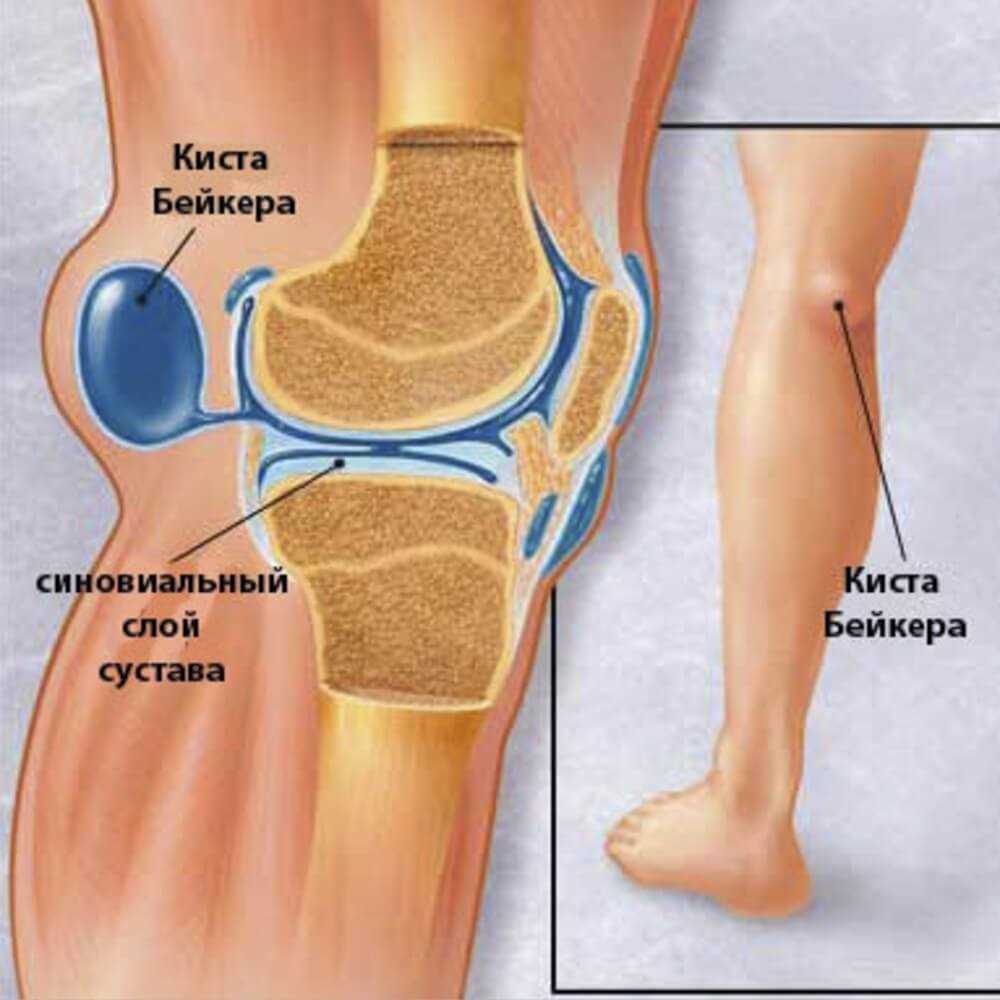 Эффективные методы лечения кисты Бейкера коленного сустава
