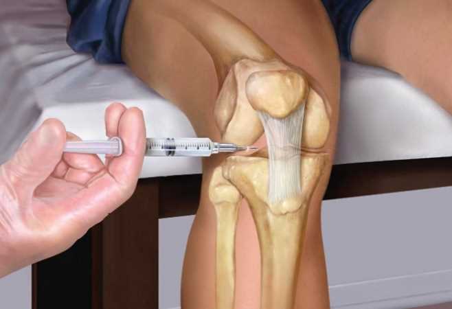 Лечение коленного сустава уколами: эффективные методы для взрослых