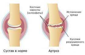 Осложнения после эндопротезирования коленного сустава