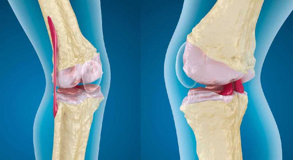 Суть анкилоза коленного сустава