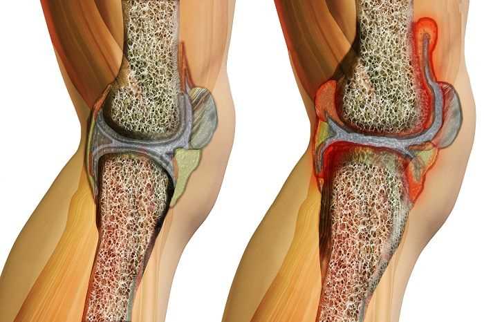 Основные признаки артрита коленного сустава