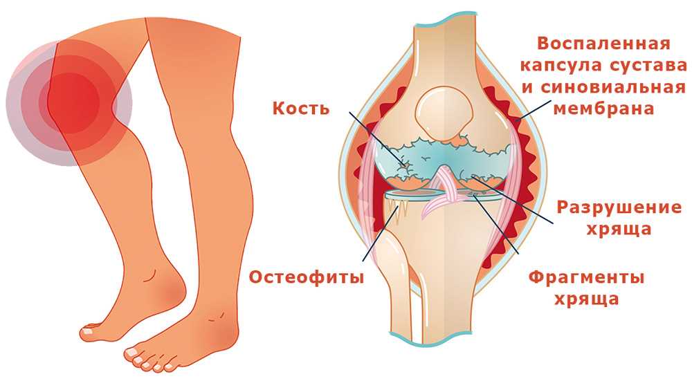Лечение артроза коленного сустава: эффективные мази и таблетки