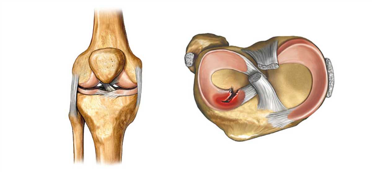 Повреждение медиального мениска коленного сустава: симптомы и диагностика