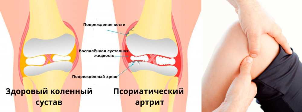 Симптомы гонита коленного сустава