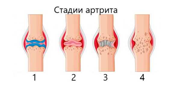 Эффективные методы лечения инфекционного артрита коленного сустава