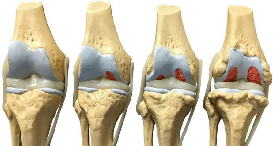 Успех лечения коленных суставов рентгеном