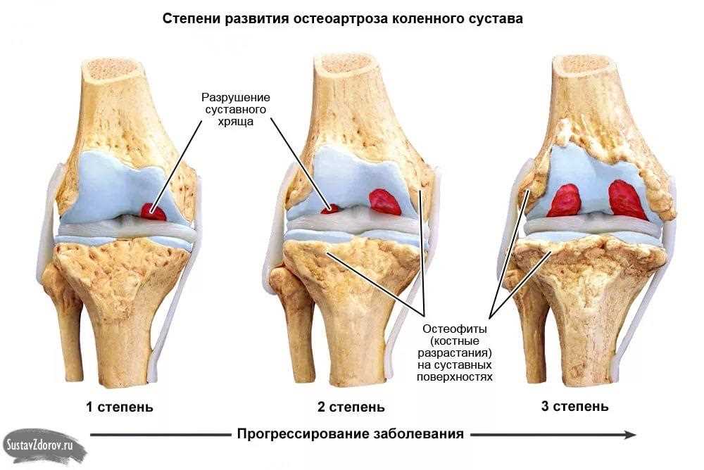 Лечение коленного сустава со стертым хрящем: эффективные методы и советы