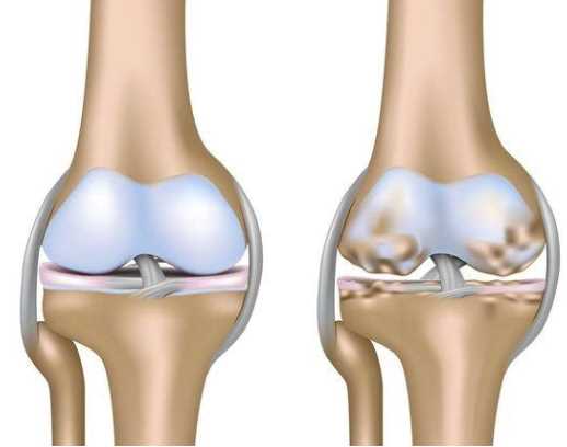 Синовит коленного сустава: основные симптомы и факторы развития