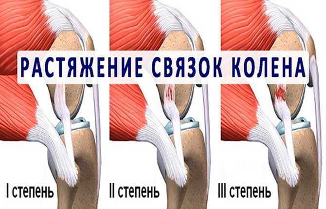 Немедикаментозное лечение разрыва внутренних связок коленного сустава