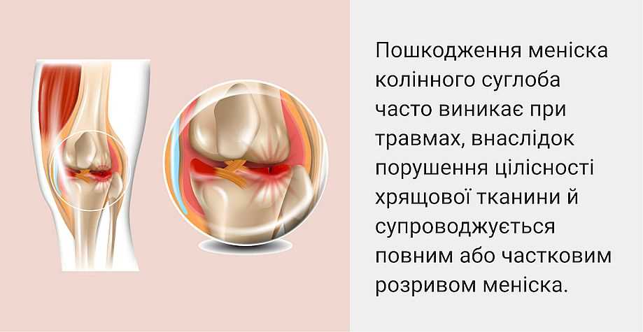 Лечение коленного сустава Lechenie-kolennogo-sustava 5256