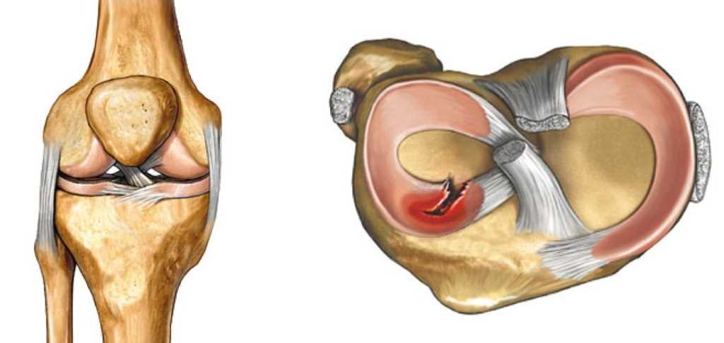 Посттравматическая артроза - одно из наиболее серьезных последствий перелома мыщелка коленного сустава