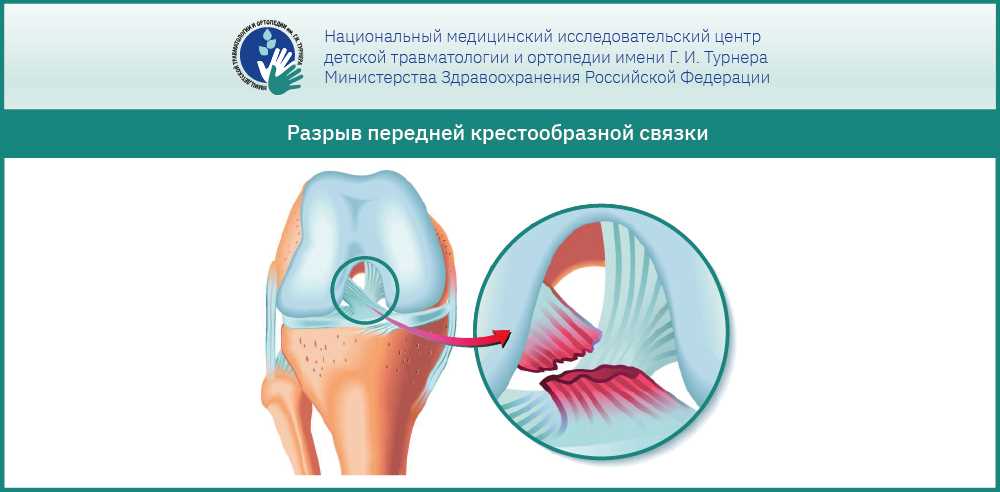 Трещина мениска коленного сустава: эффективное лечение