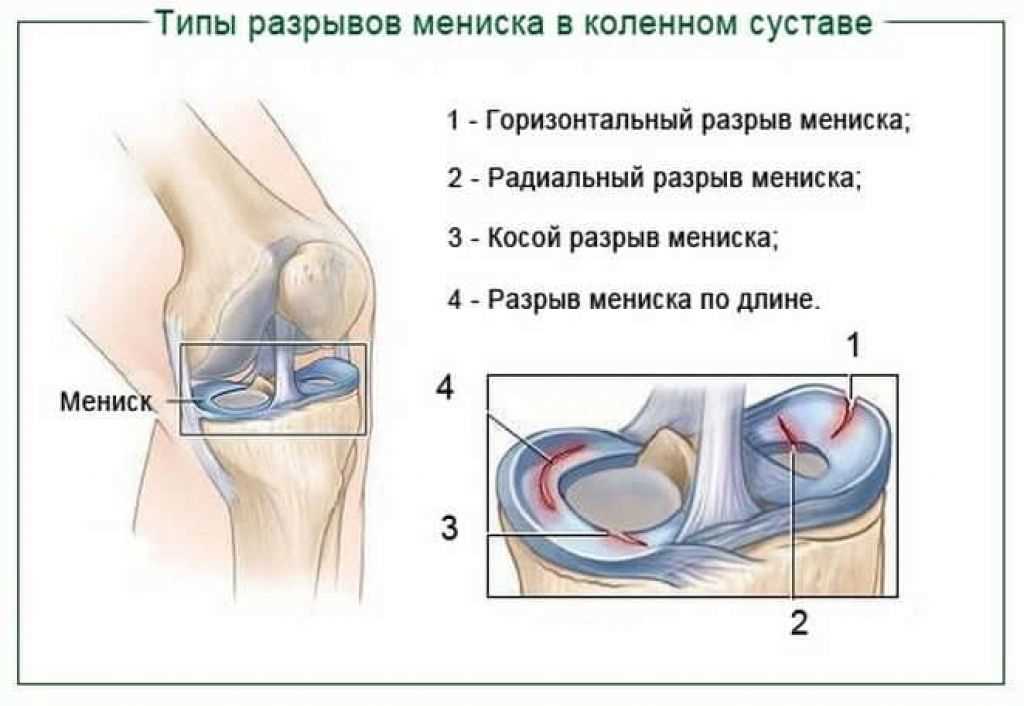 Повреждение связок коленного сустава: симптомы, лечение и профилактика
