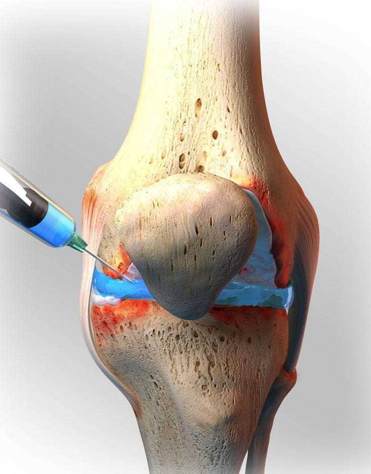 Лечение коленного сустава уколами гиалуроновой кислоты