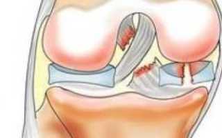 Лечение разрыва мениска коленного сустава народными средствами и методы восстановления