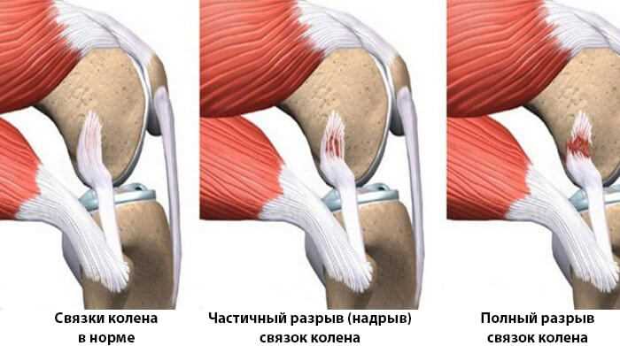 Консервативное лечение разрыва связок коленного сустава