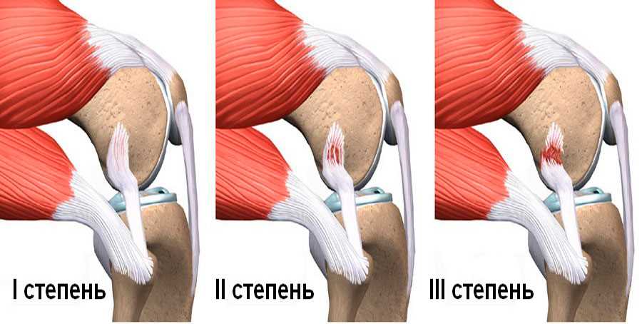 Симптомы разрыва связок коленного сустава