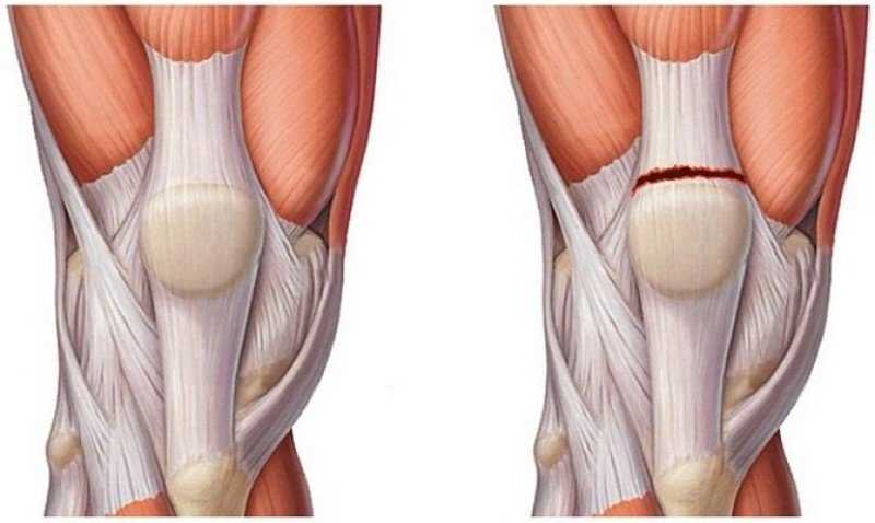 Хирургическое лечение разрыва связок коленного сустава
