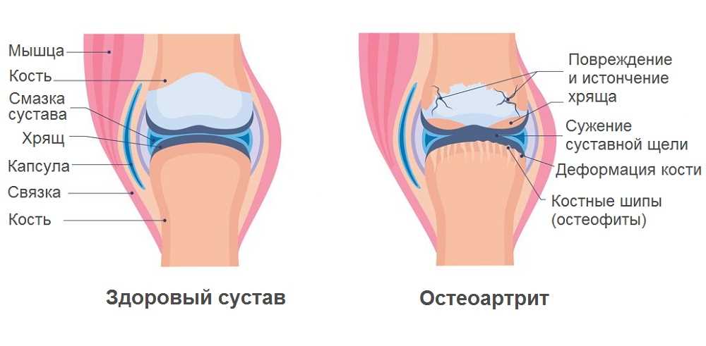 Эффективное лечение ревматоидного артроза коленного сустава