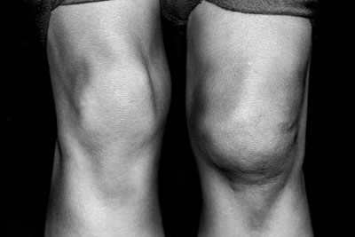 Основные симптомы коленного синовита