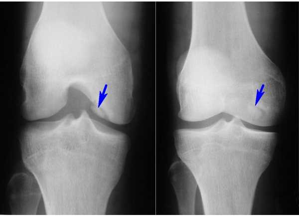 Хондроматоз коленного сустава: основные причины и симптомы
