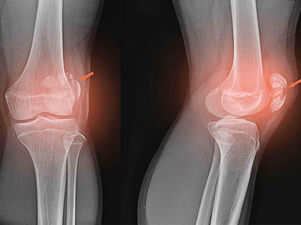 Профилактика хондроматоза коленного сустава: советы и рекомендации