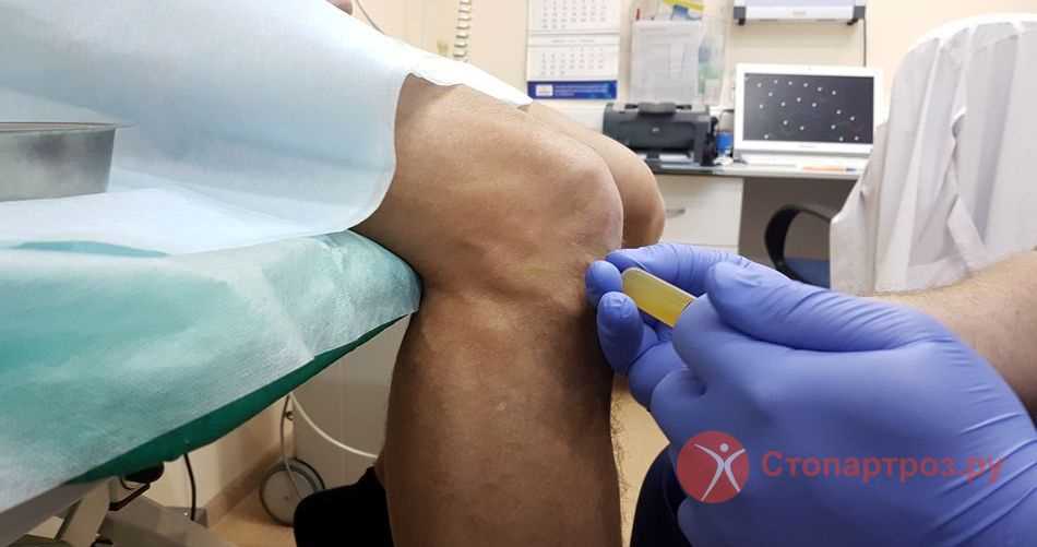 Методы лечения защемления мениска коленного сустава